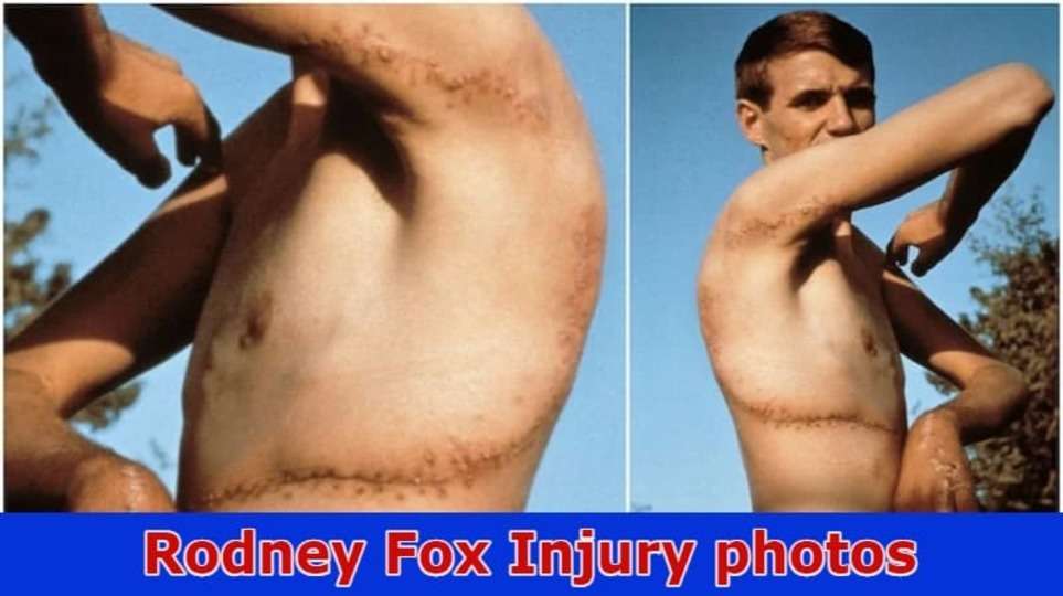 {Watch}Rodney Fox Injury Photos: Explore Information On Rodney Fox Shark Museum, And Rodney Fox Shark Photos And More 2023